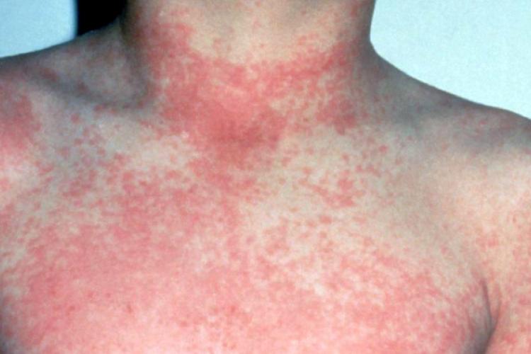 Outbreak of Scarlet Fever in Brăila: 5 Cases Confirmed, 10 Suspected – According to DSP Brăila