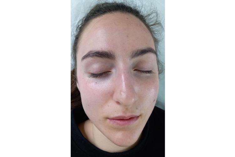 Isabelle SPA. Ce sunt mezoterapiile featured image