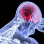 Semnele unui accident vascular cerebral pe care nu trebuie să le ignori. Ce trebuie făcut în primele minute